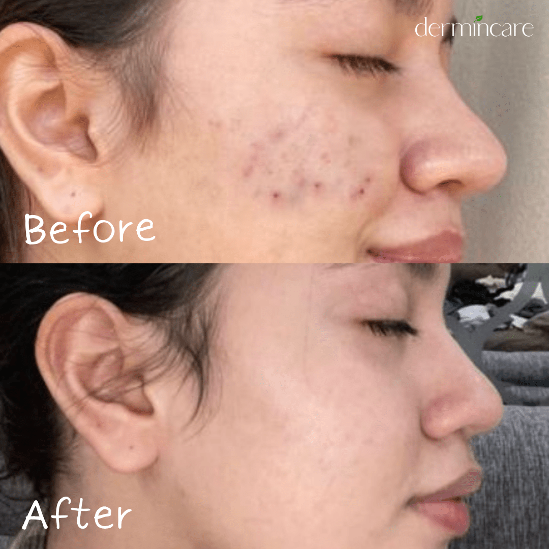 Tea Tree Acne Face Wash