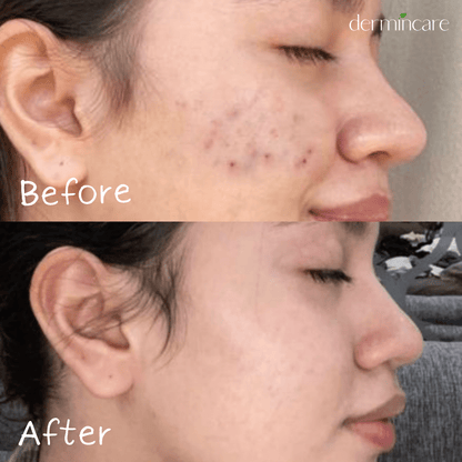 Tea Tree Acne Face Wash